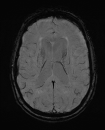 File:Alzheimer's disease- with Gerstmann syndrome and dressing apraxia (Radiopaedia 54882-61150 Axial SWI 21).png