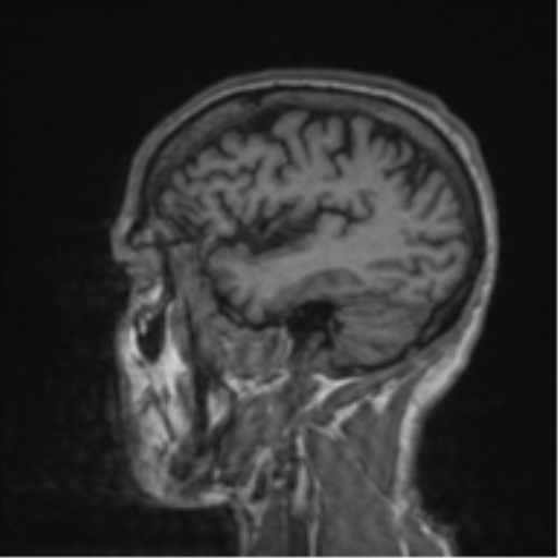 File:Alzheimer's disease- with apraxia (Radiopaedia 54763-61011 Sagittal T1 15).png