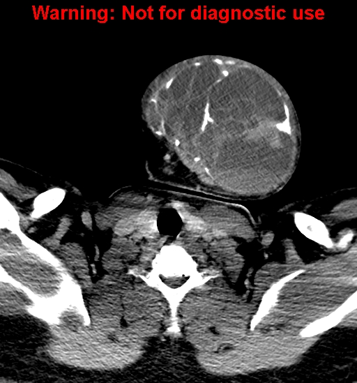 File:Ameloblastoma (Radiopaedia 33126-34164 B 32).jpg