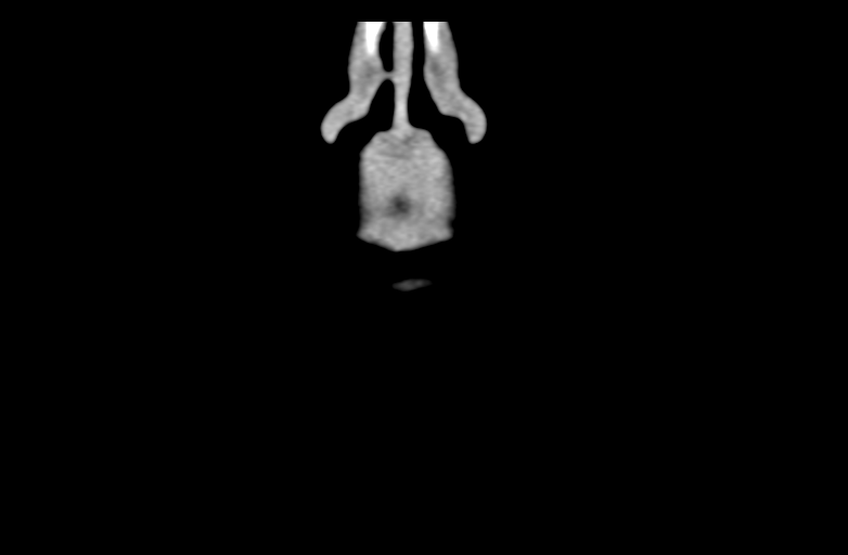 Ameloblastoma (Radiopaedia 33677-34806 Coronal non-contrast 8).png