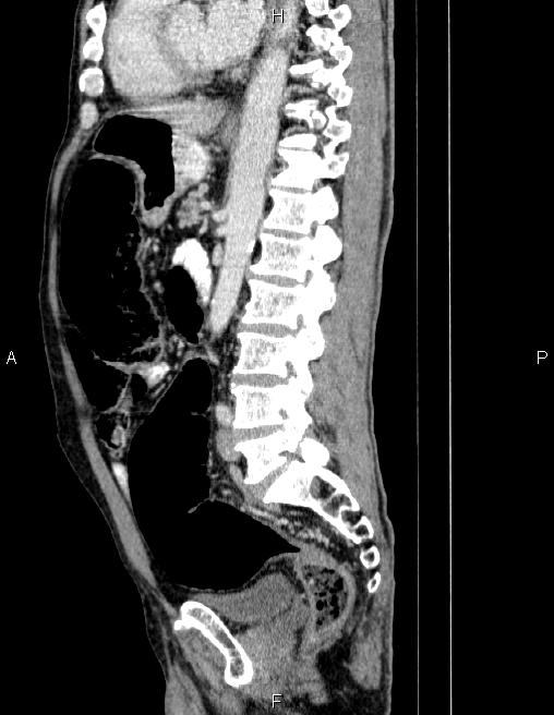 Ampullary adenocarcinoma (Radiopaedia 86093-102032 D 55).jpg