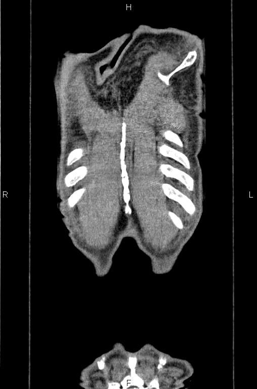 Ampullary adenocarcinoma (Radiopaedia 86093-102033 D 62).jpg