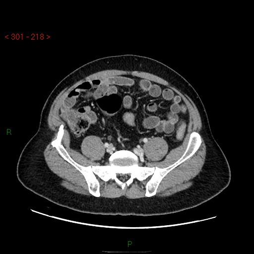 Ampullary carcinoma (Radiopaedia 56396-63056 C 73).jpg