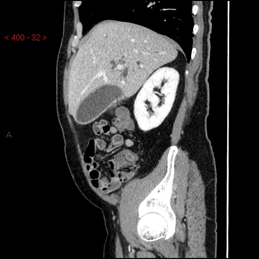 Ampullary carcinoma (Radiopaedia 56396-63056 D 31).jpg