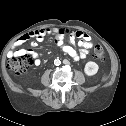 File:Amyand hernia (Radiopaedia 39300-41547 A 38).png