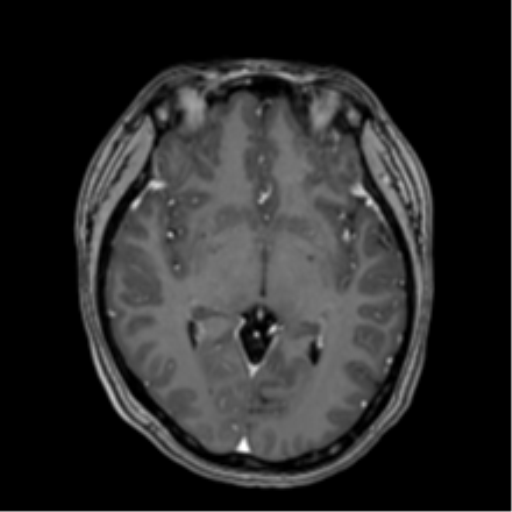 Anaplastic astroblastoma (Radiopaedia 55666-62194 Axial T1 C+ 35).png