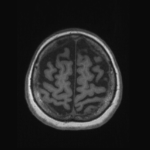 Anaplastic astrocytoma IDH wild-type (pseudoprogression) (Radiopaedia 42209-45276 Axial T1 125).png