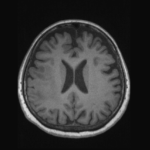 Anaplastic astrocytoma IDH wild-type (pseudoprogression) (Radiopaedia 42209-45276 Axial T1 96).png