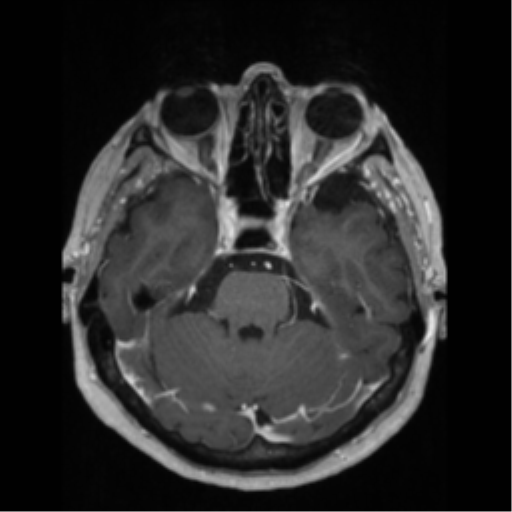 File:Anaplastic astrocytoma IDH wild-type (pseudoprogression) (Radiopaedia 42209-45276 Axial T1 C+ 52).png