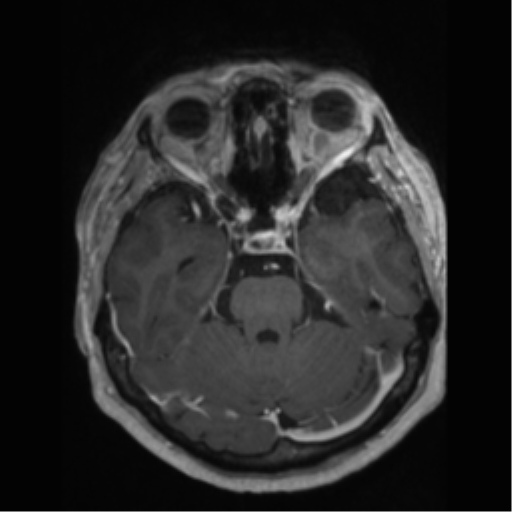 File:Anaplastic astrocytoma IDH wild-type (pseudoprogression) (Radiopaedia 42209-45277 Axial T1 C+ 39).png