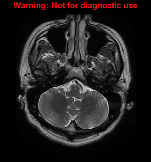 File:Anaplastic ganglioglioma (Radiopaedia 44921-48831 Axial T2 6).jpg