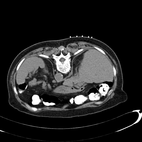 File:Anaplastic lymphoma - with CT biopsy (Radiopaedia 21643-21602 Axial non-contrast 7).jpg