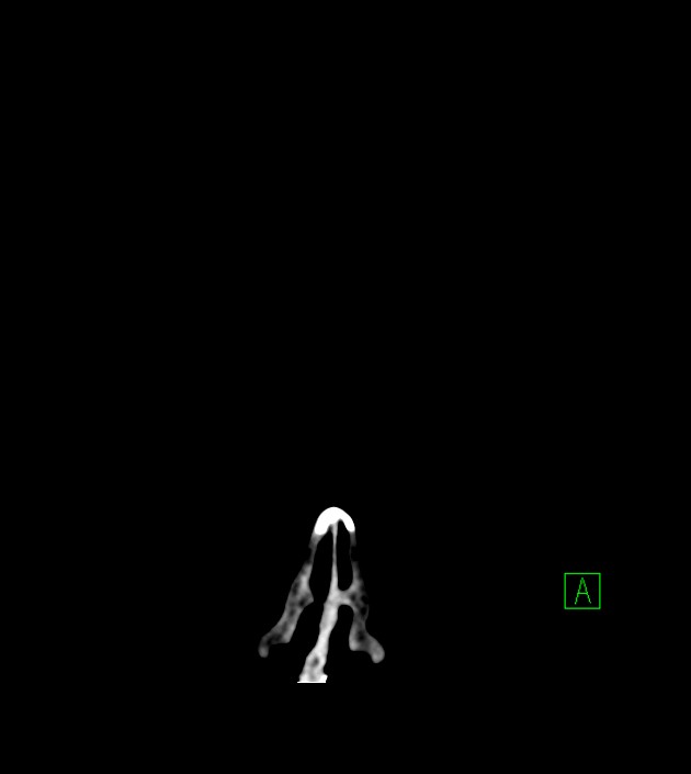 Anaplastic oligodendroglioma (Radiopaedia 79571-92758 Coronal non-contrast 1).jpg