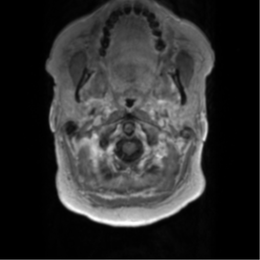 Anaplastic oligodendroglioma (Radiopaedia 83500-98599 Axial T1 C+ 5).png