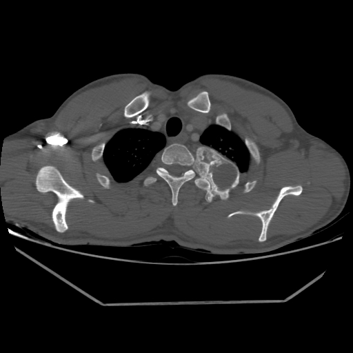 Aneurysmal bone cyst - rib (Radiopaedia 82167-96220 Axial bone window 59).jpg
