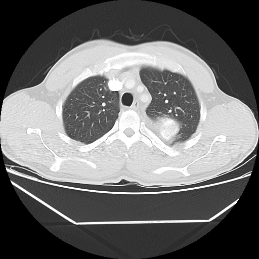 File:Aneurysmal bone cyst - rib (Radiopaedia 82167-96220 Axial lung window 22).jpg