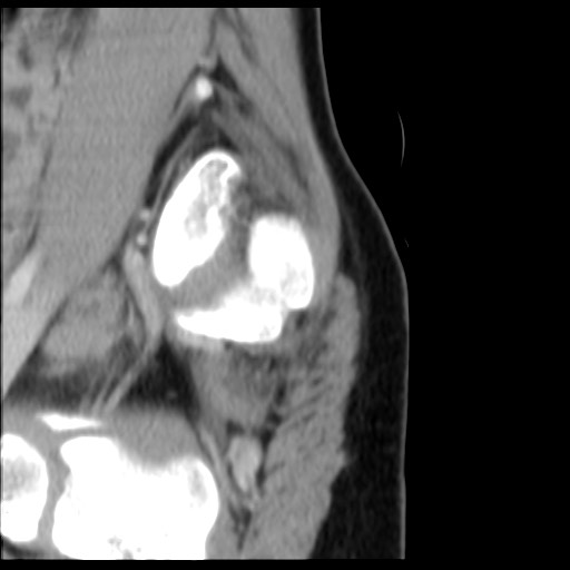 File:Aneurysmal bone cyst - sacrum (Radiopaedia 65190-74195 A 28).jpg