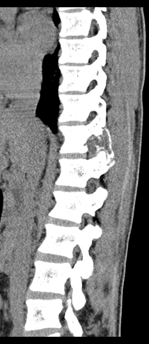 Aneurysmal bone cyst T11 (Radiopaedia 29294-29721 E 49).jpg