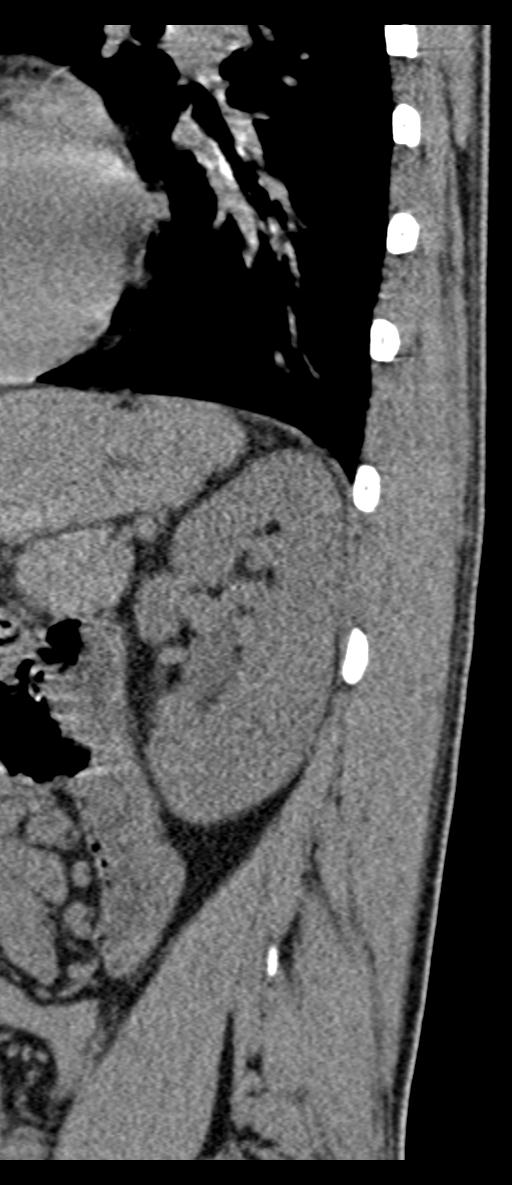 Aneurysmal bone cyst T11 (Radiopaedia 29294-29721 E 5).jpg