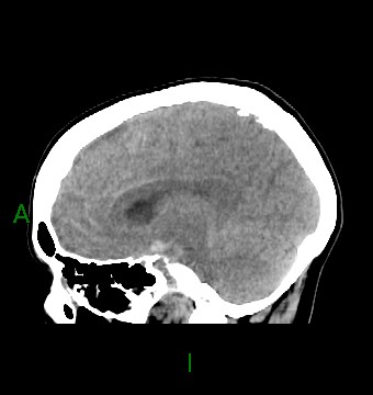 File:Aneurysmal subarachnoid hemorrhage with intra-axial extension (Radiopaedia 84371-99699 B 28).jpg