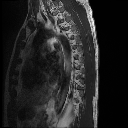 File:Angiolipoma - thoracic spine (Radiopaedia 28242-28479 Sagittal T1 1).jpg