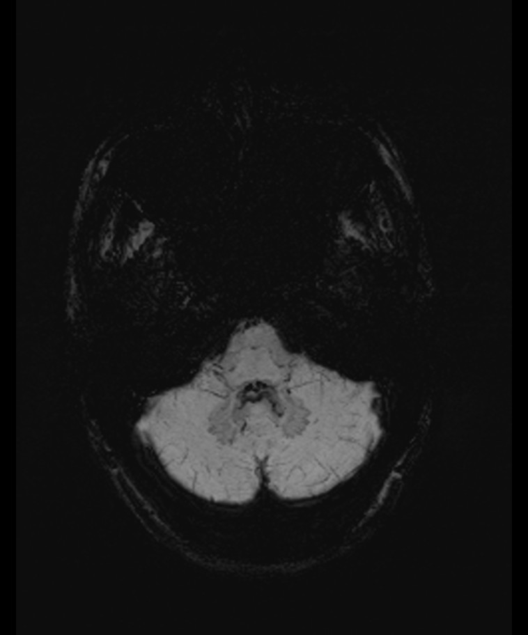 Angiomatous meningioma (Radiopaedia 79459-92579 E 10).jpg