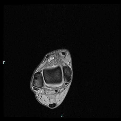 Ankle ganglion cyst (Radiopaedia 62809-71162 Axial Gradient Echo 64).jpg