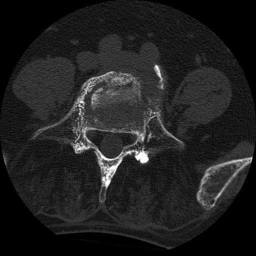 Ankylosing spondylitis complicated by fracture-dislocation (Radiopaedia 33583-34674 Axial non-contrast 124).jpg
