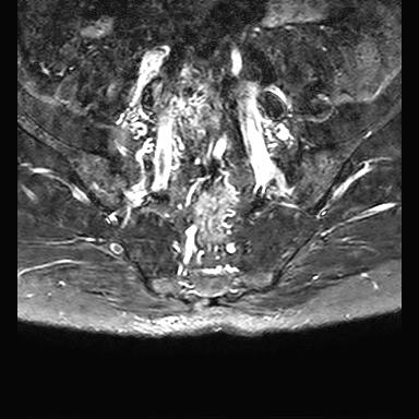 File:Ankylosing spondylitis with zygapophyseal arthritis (Radiopaedia 38433-40517 D 1).jpg