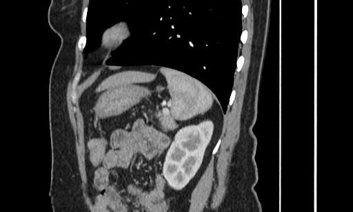 Annular pancreas (Radiopaedia 70359-80453 B 49).jpg