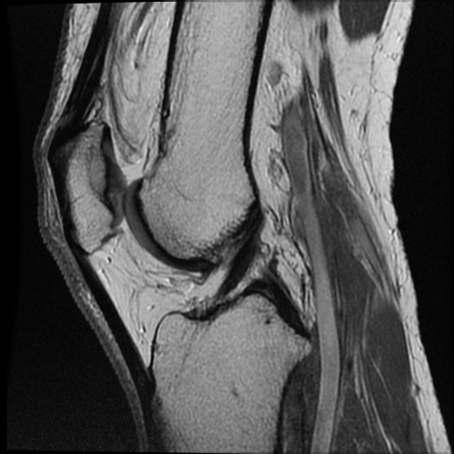 Anomalous insertion of the medial meniscus (Radiopaedia 77559-89721 Sagittal PD 26).jpg