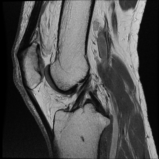 File:Anomalous insertion of the medial meniscus (Radiopaedia 77559-89721 Sagittal PD 27).jpg