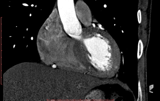 Anomalous left coronary artery from the pulmonary artery (ALCAPA) (Radiopaedia 70148-80181 B 116).jpg
