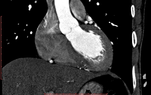 Anomalous left coronary artery from the pulmonary artery (ALCAPA) (Radiopaedia 70148-80181 B 129).jpg