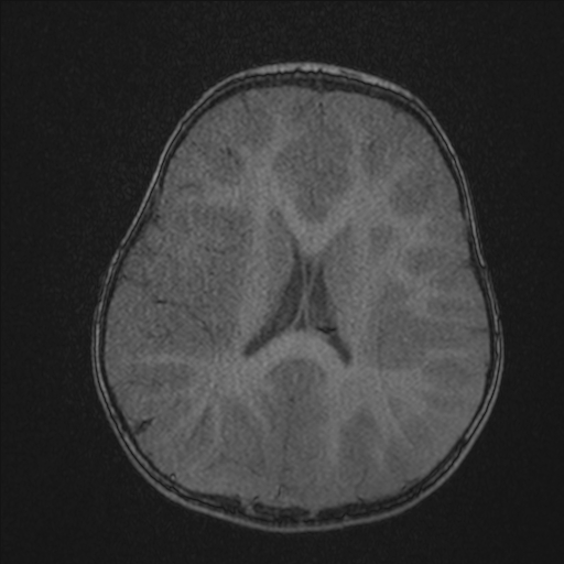 Anoxic brain injury (Radiopaedia 79165-92139 Axial MRA 159).jpg