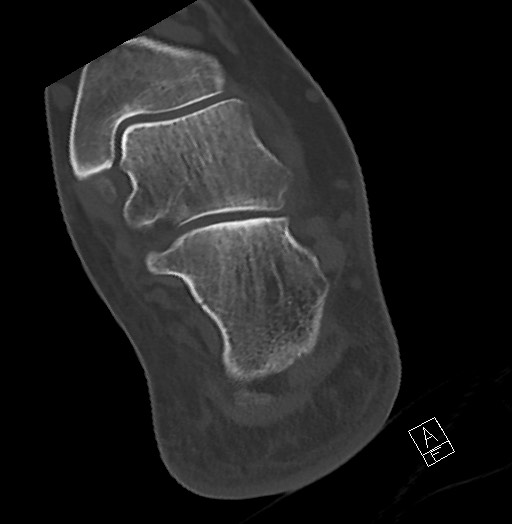 Anterior calcaneal process fracture (Radiopaedia 63353-71943 Axial bone window 104).jpg