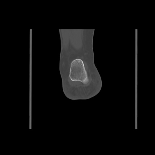 File:Anterior calcaneal process fracture (Radiopaedia 82590-96762 Coronal bone window 66).jpg