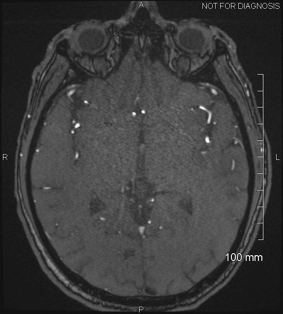Anterior cerebral artery aneurysm (Radiopaedia 80683-94127 Axial MRA 116).jpg