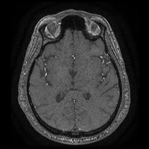 Anterior cerebral artery infarction (Radiopaedia 46794-51323 Axial MRA 114).jpg
