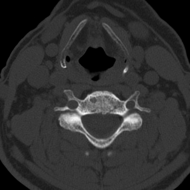 Anterior cervical postdiscectomy arthrodesis (Radiopaedia 32678-33646 Axial bone window 43).jpg