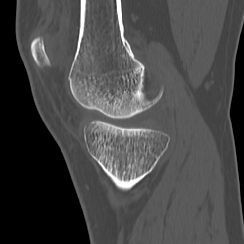 File:Anterior cruciate ligament avulsion fracture (Radiopaedia 58939-66194 Sagittal bone window 28).jpg