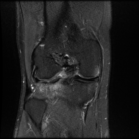 File:Anterior cruciate ligament graft tear and bucket-handle tear of medial meniscus (Radiopaedia 75867-87254 Coronal PD fat sat 16).jpg