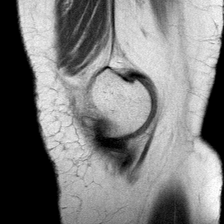 File:Anterior cruciate ligament mucoid degeneration (Radiopaedia 60853-68633 Sagittal PD 8).jpg