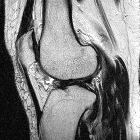 File:Anterior cruciate ligament mucoid degeneration (Radiopaedia 60853-68633 Sagittal T2 19).jpg