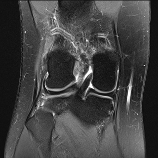 File:Anterior cruciate ligament rupture and posteromedial corner injury (Radiopaedia 67338-76723 Coronal PD fat sat 8).jpg