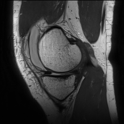 Anterior cruciate ligament rupture with Segond fracture (Radiopaedia 69043-78806 Sagittal PD 55).jpg