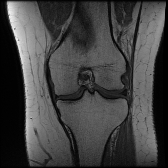 File:Anterior cruciate ligament tear, Wrisberg rip and bucket-handle tear of medial meniscus (Radiopaedia 75872-87266 Coronal T1 16).jpg