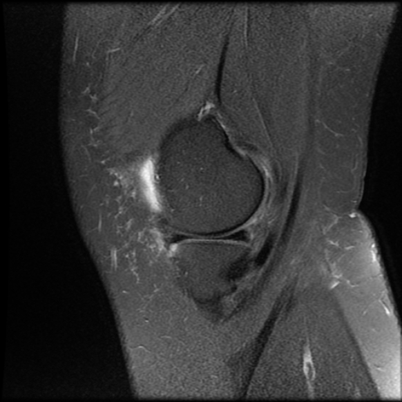 File:Anterior cruciate ligament tear, Wrisberg rip and bucket-handle tear of medial meniscus (Radiopaedia 75872-87266 Sagittal PD fat sat 22).jpg