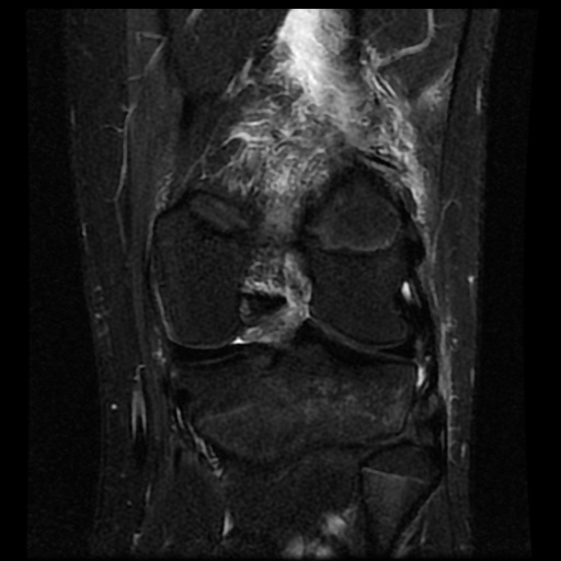 File:Anterior cruciate ligament tear (Radiopaedia 61500-69462 Coronal STIR 14).jpg