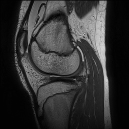 Anterior cruciate ligament tear - pediatric (Radiopaedia 62152-70260 Sagittal PD 115).jpg